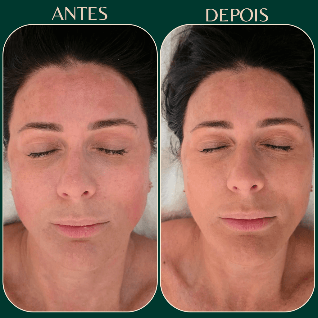 Resultado antes e depois